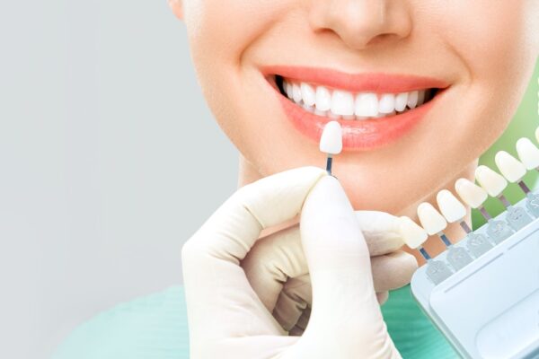 Tooth-Colored Composite Fillings