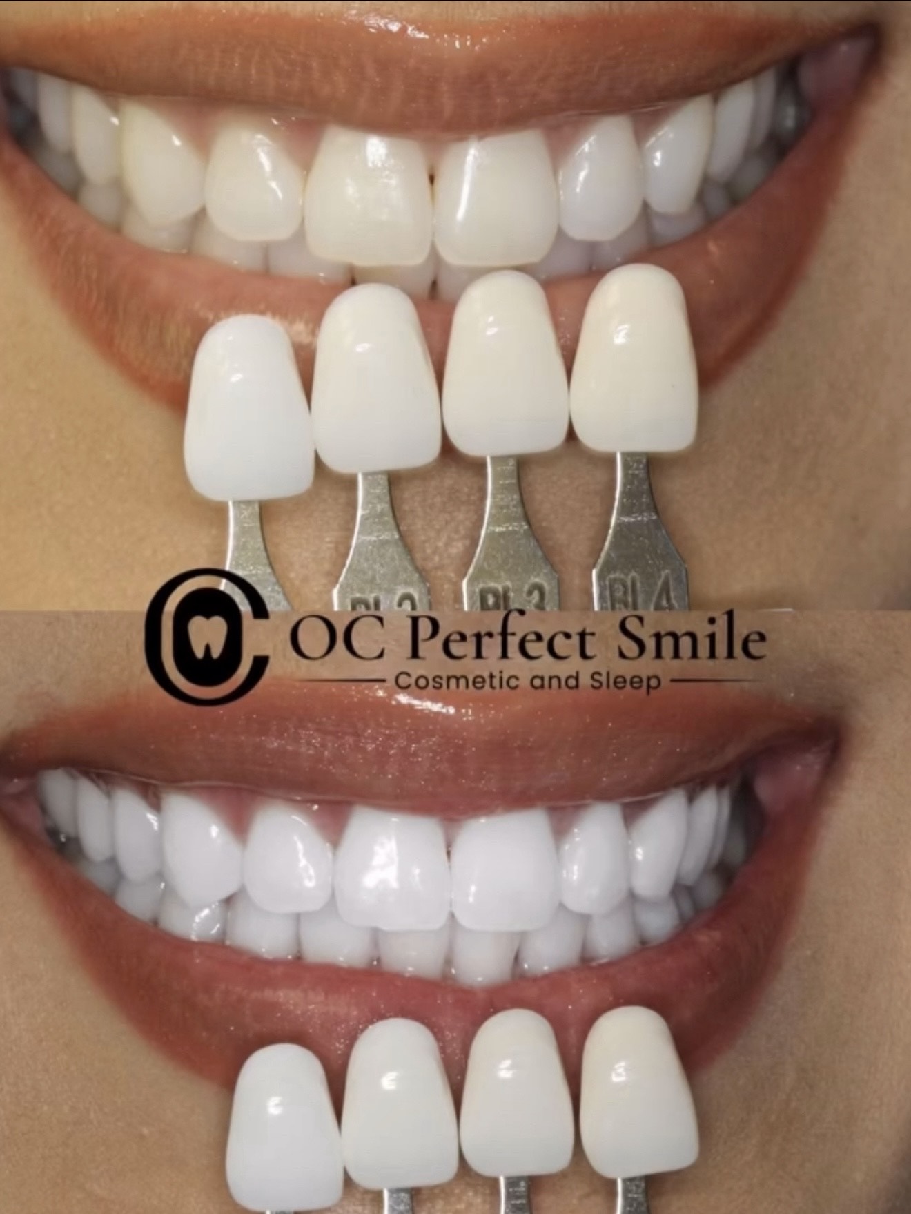 Smile Gallery - Dr. H - OCPerfectSmileDental