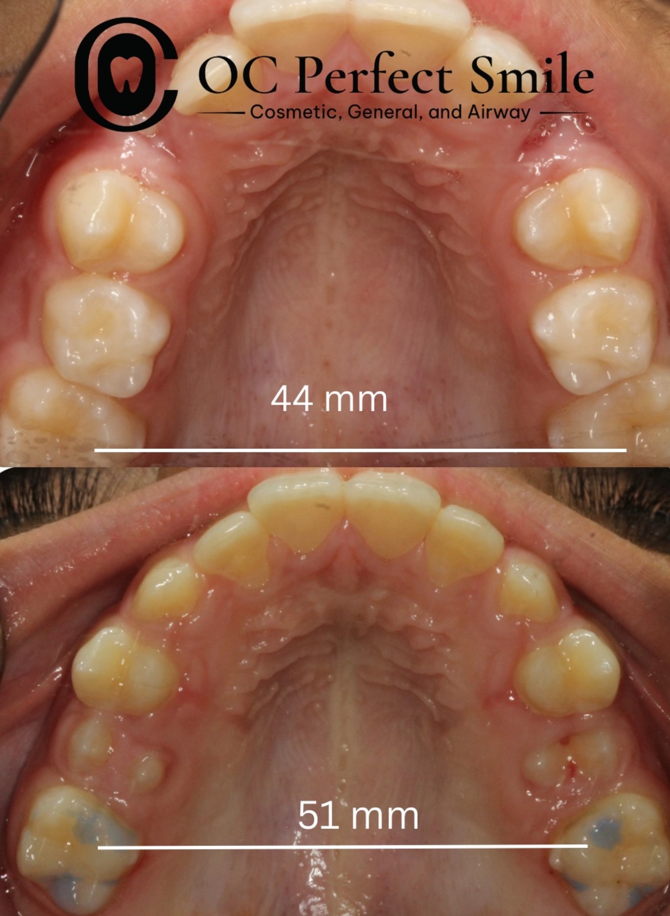 Smile Gallery - Dr. H - OCPerfectSmileDental