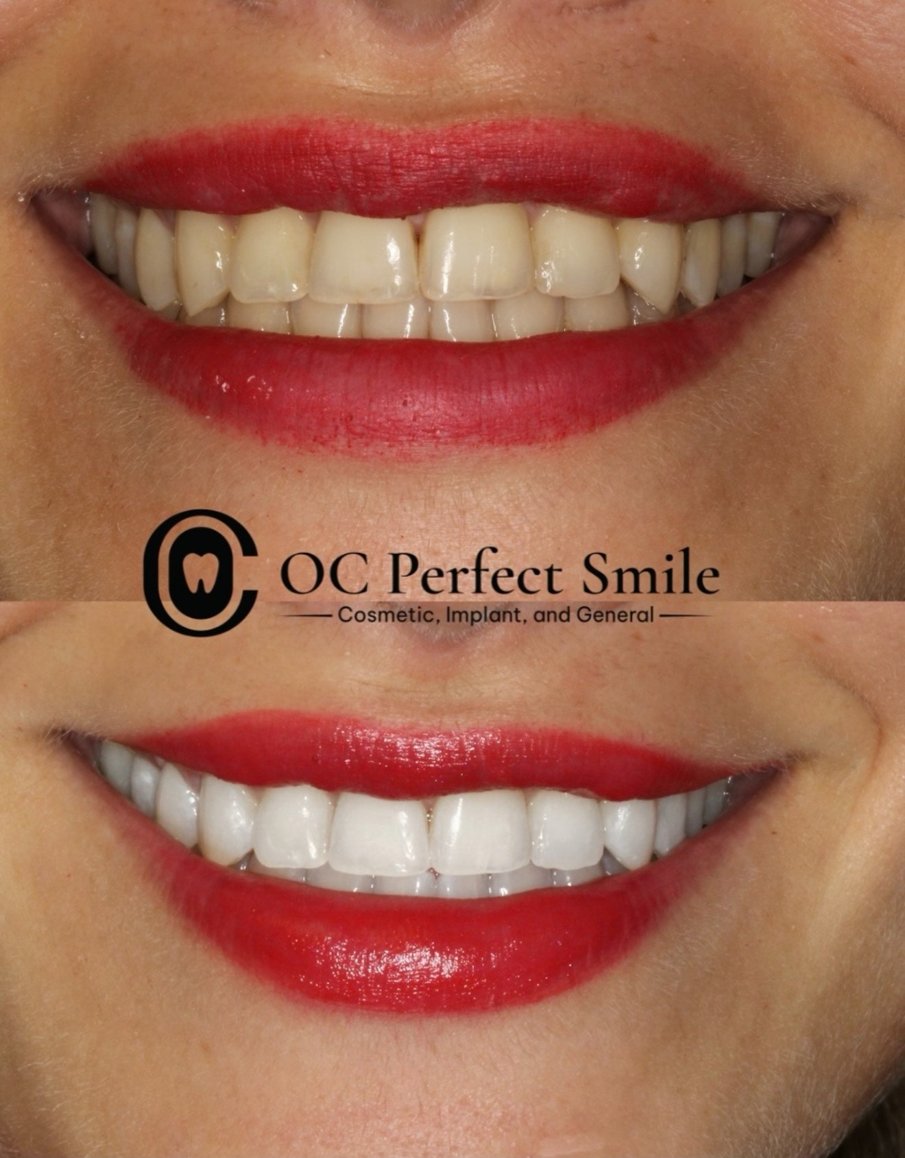 Smile Gallery - Dr. H - OCPerfectSmileDental