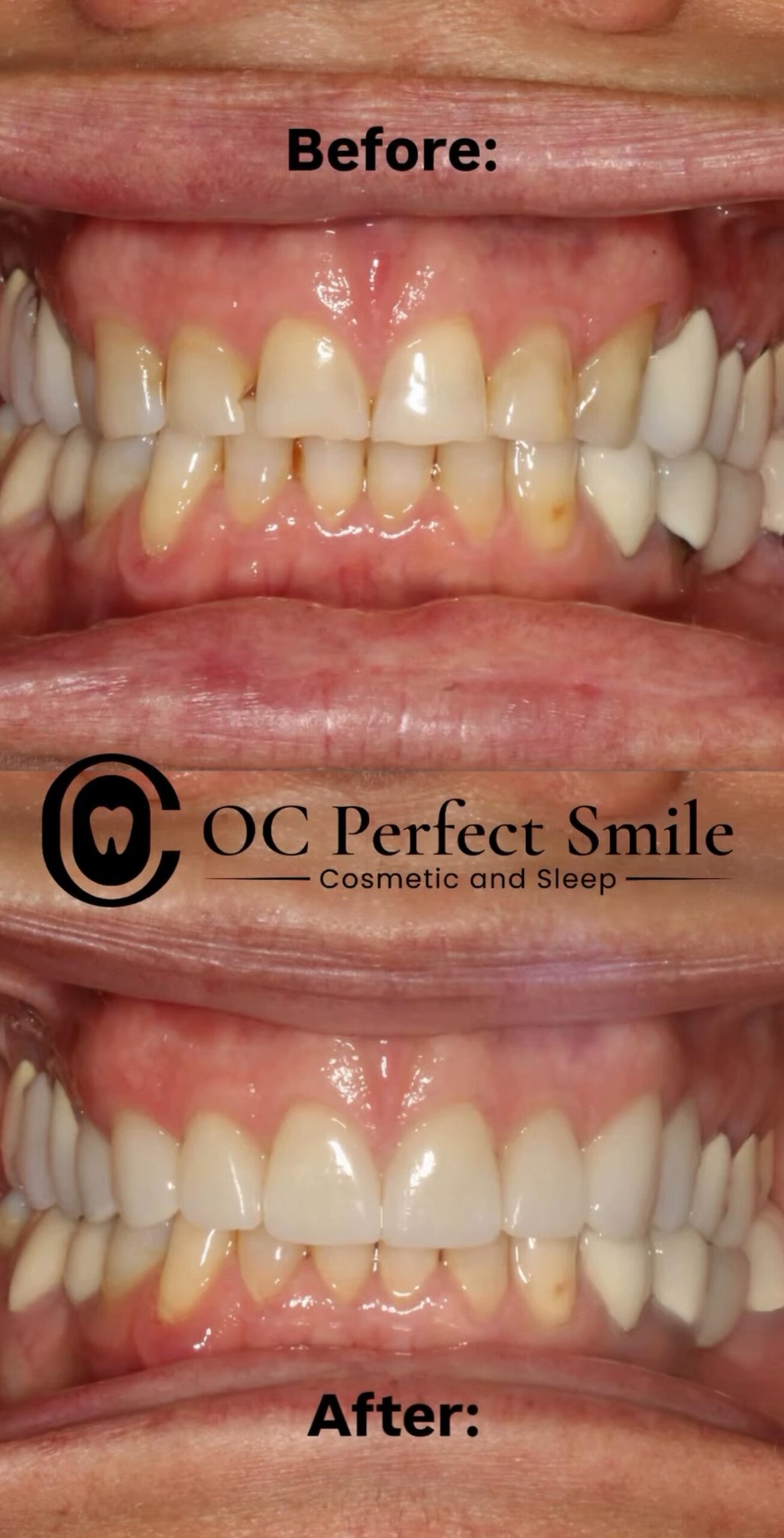 Smile Gallery - Dr. H - OCPerfectSmileDental