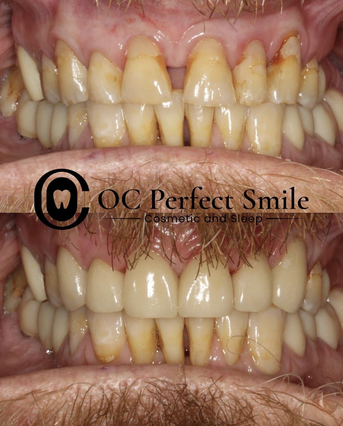 Smile Gallery - Dr. H - OCPerfectSmileDental