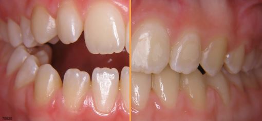 FastBraces: Revolutionizing Orthodontics