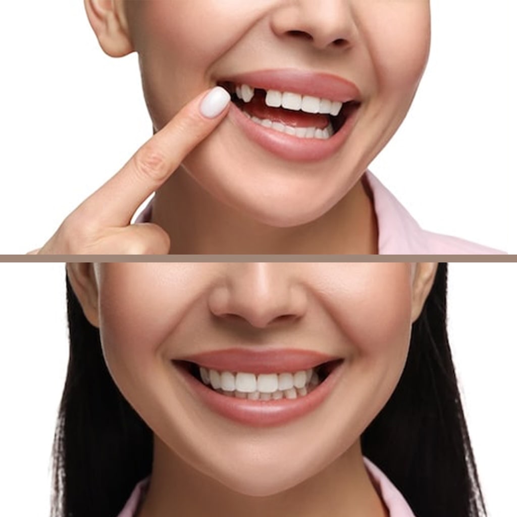 Digital Dental Implants: Revolutionizing Modern Implant Dentistry