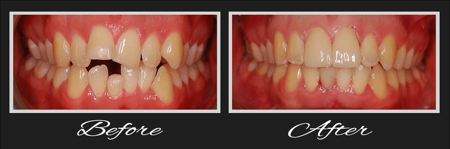 Digital dental implant planning using CBCT and 3D technology at OC Perfect Smile