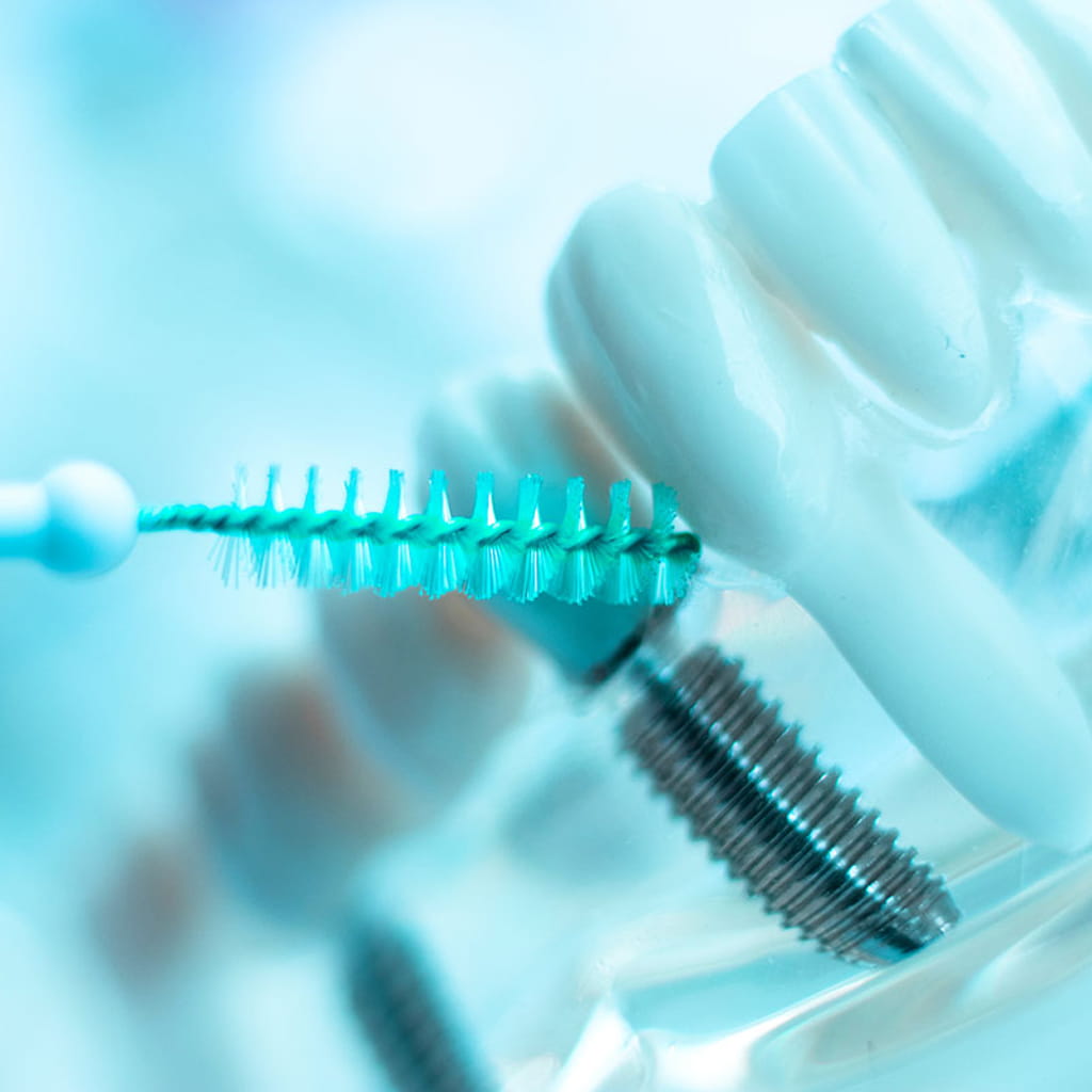 How to Properly Care for Dental Implants: Flossing and Cleaning Tips from Your Orange County Dentist
