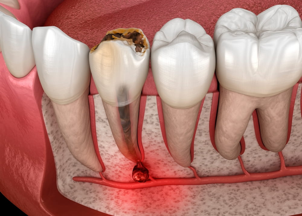 Root Canal Treatment in Laguna Hills