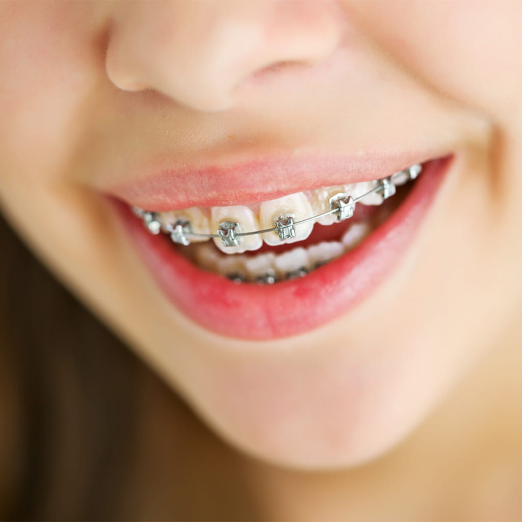 Braces for Children: When to Start and What Parents Should Know