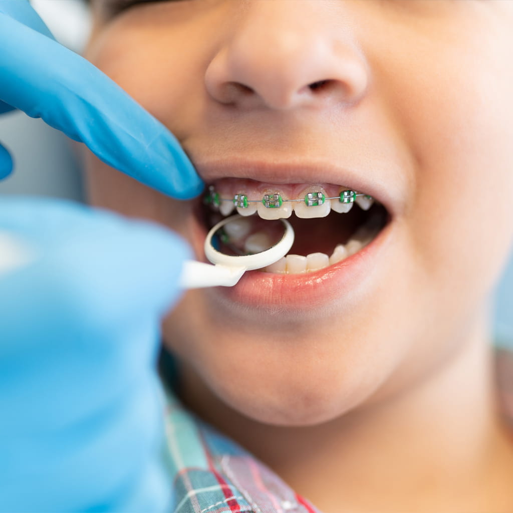 Braces for Children: When to Start and What Parents Should Know