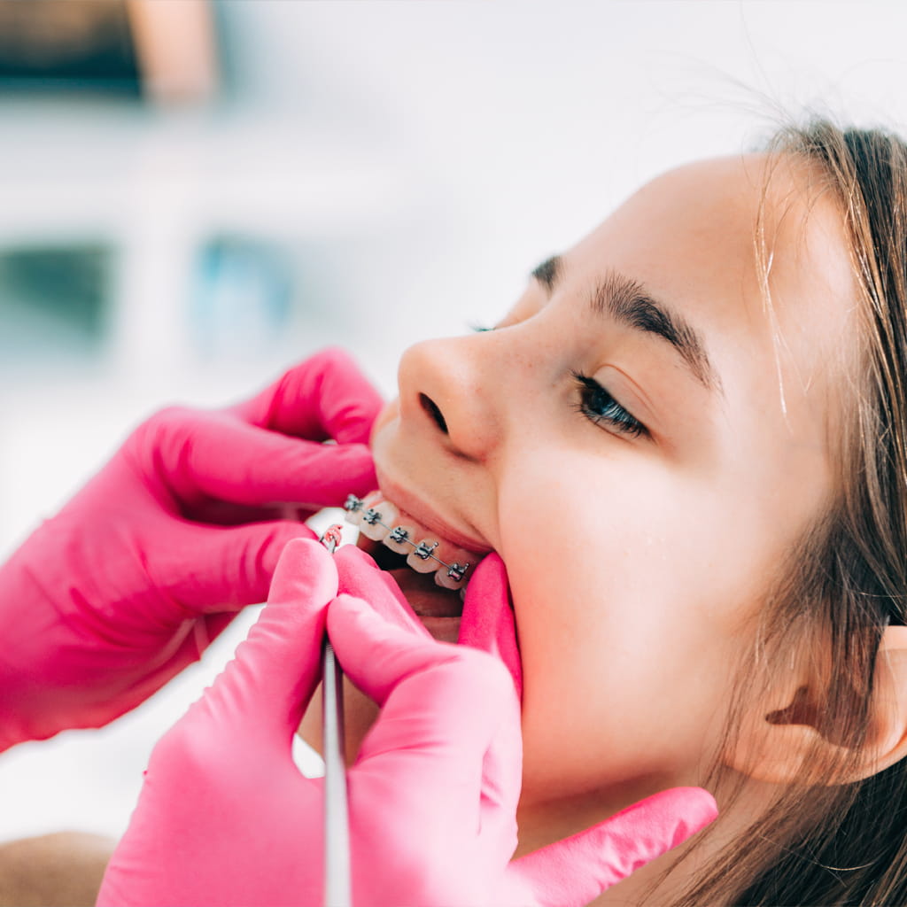 Braces for Children: When to Start and What Parents Should Know