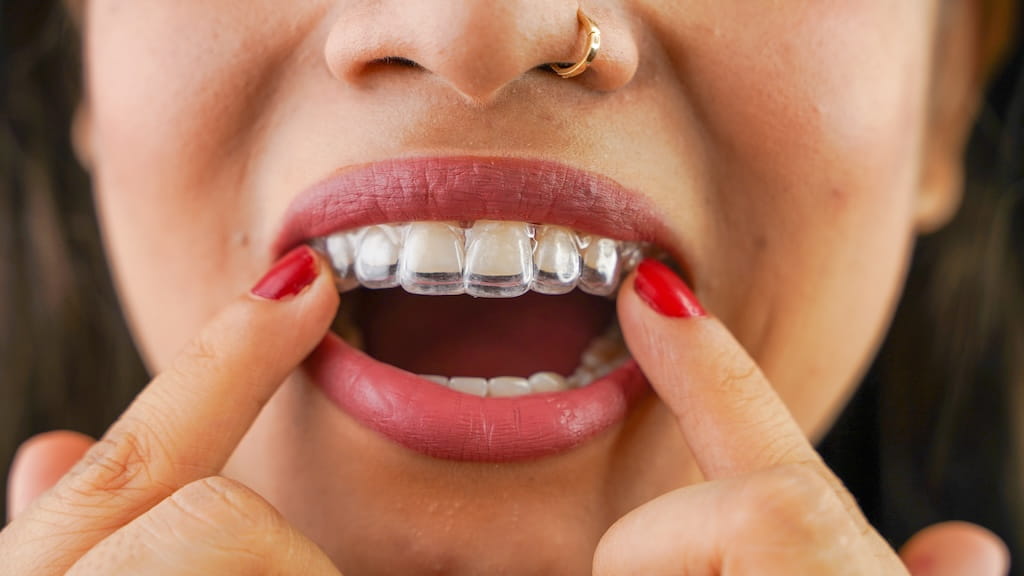 Is Invisalign Right for You? What to Know About Clear Aligners at OC Perfect Smile in Laguna Hills
