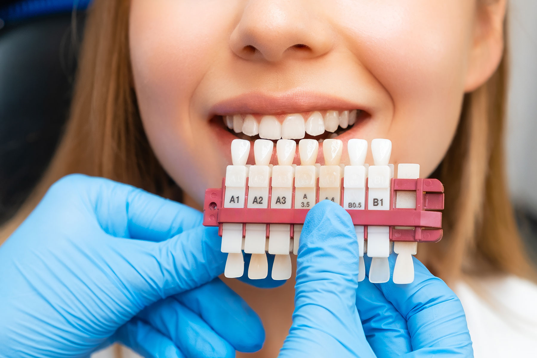 Professional teeth whitening consultation at OC Perfect Smile in Laguna Hills