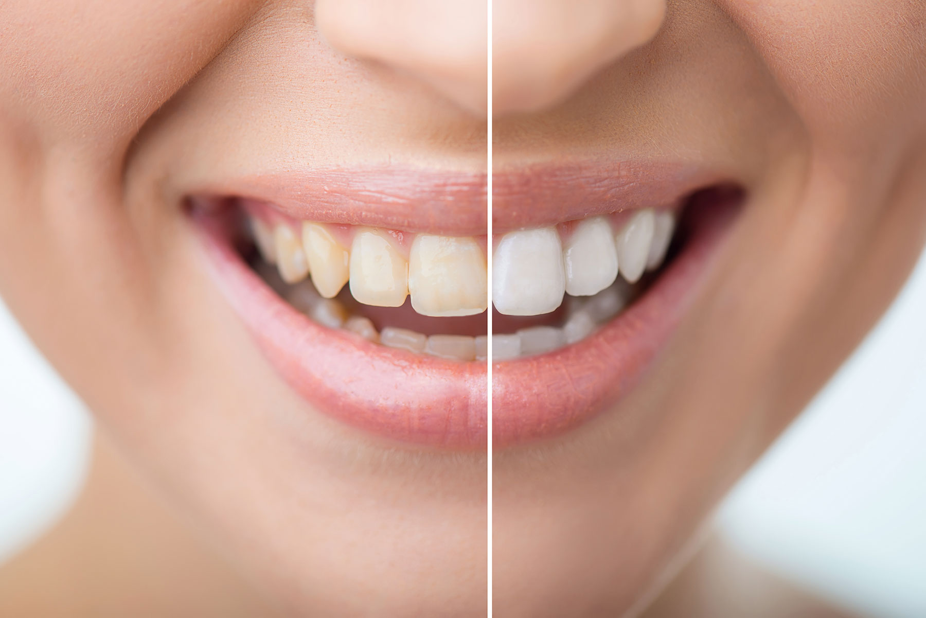 Teeth whitening treatment planning and results in Laguna Hills