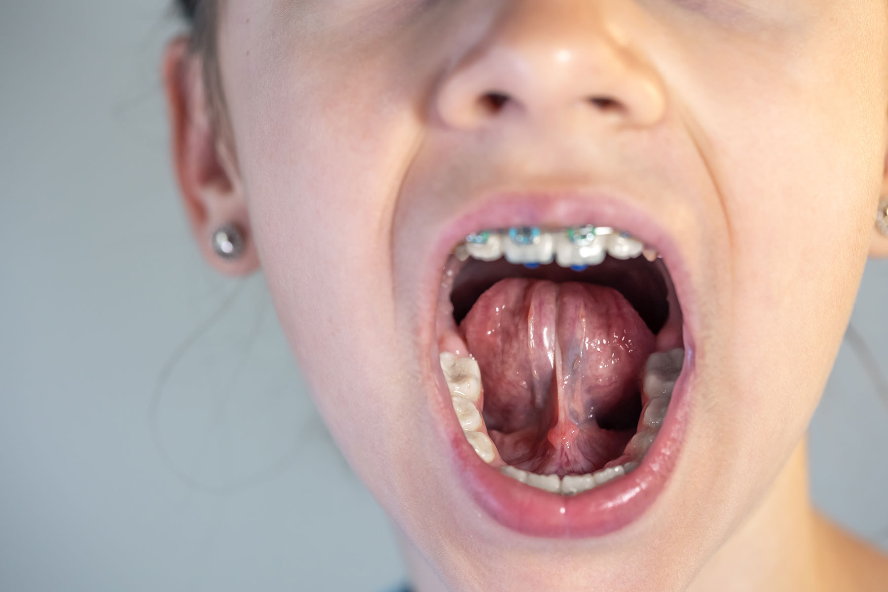 Orthodontic treatment planning for kids braces in Laguna Hills