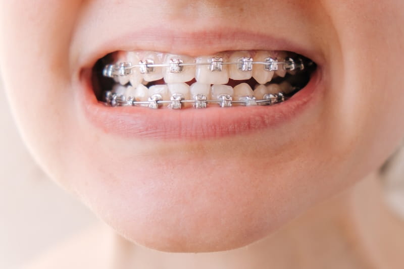 Kids Orthodontics: Why Early Evaluation Matters for Your Child’s Long-Term Health