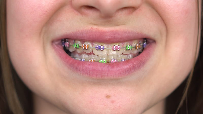 Kids Orthodontics: Why Early Evaluation Matters for Your Child’s Long-Term Health