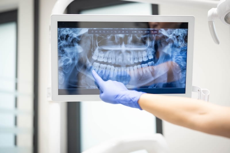 Are Dental X Rays Harmful to the Body? Understanding the Facts About Dental Radiation