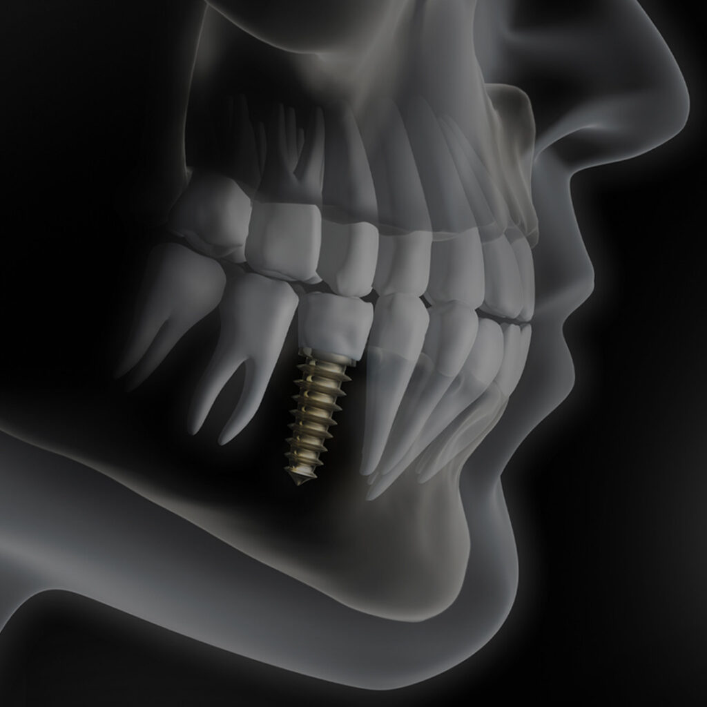 Digital Implants - ocperfectsmiledental