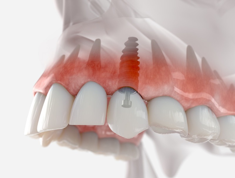 Zirconia Dental Implants in Laguna Hills: Are Metal-Free Implants the Right Choice?