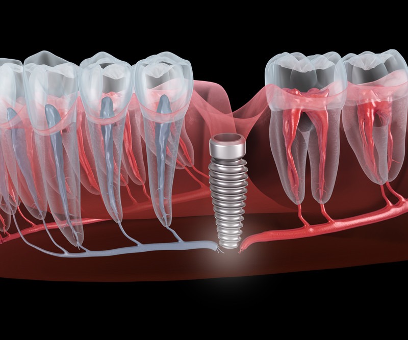 Dental Implants and Pregnancy: What Expecting Mothers Should Know - ocperfectsmiledental