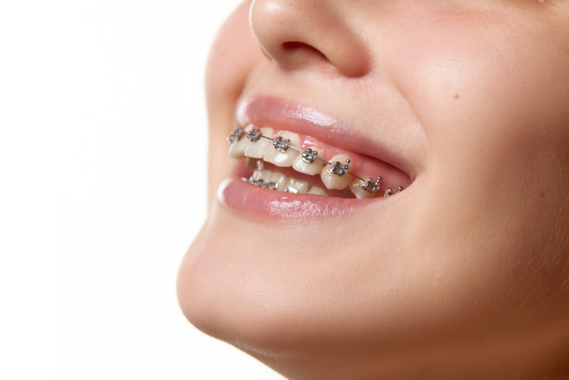 Do You Really Need Teeth Pulled for Braces?