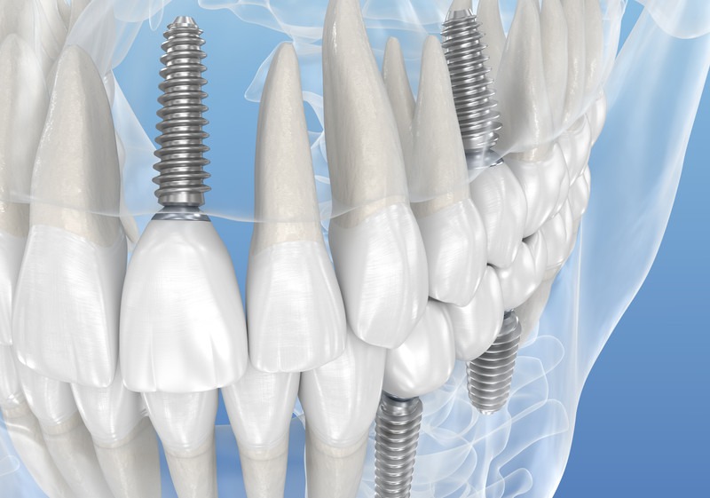 Discover the future of digital dental implants in Laguna Hills