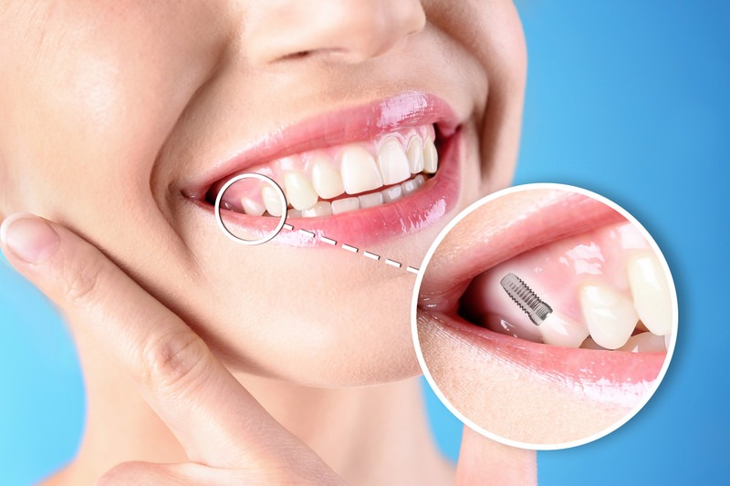 Discover the future of digital dental implants in Laguna Hills