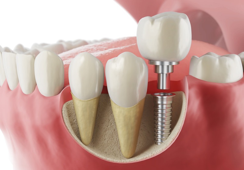 Discover the future of digital dental implants in Laguna Hills