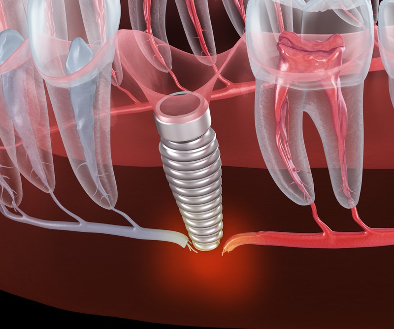 Why Do Dental Implants Fail and How Can You Avoid It?