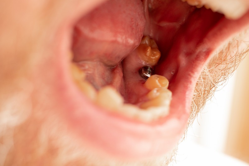 Why Do Dental Implants Fail and How Can You Avoid It?