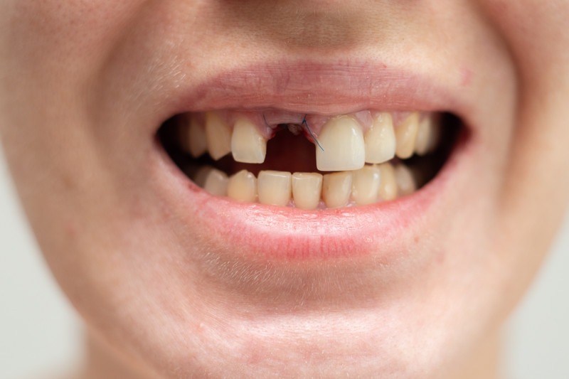 Why Do Dental Implants Fail and How Can You Avoid It?