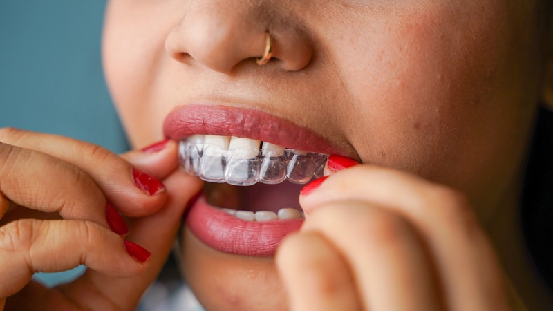 Are Clear Aligners Better Than Traditional Braces for Adults?