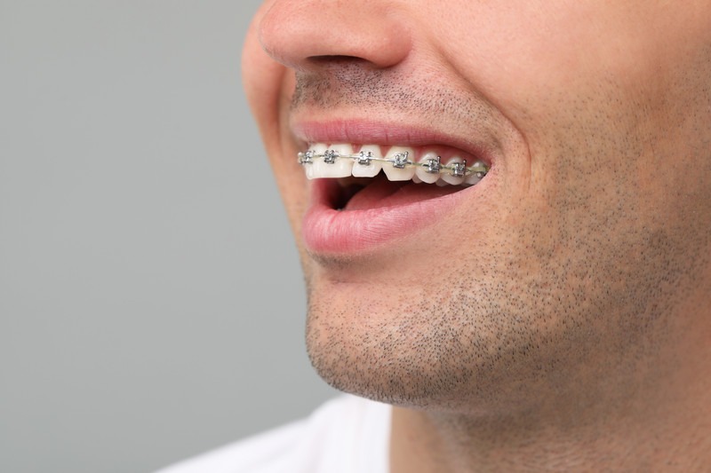 Are Clear Aligners Better Than Traditional Braces for Adults?