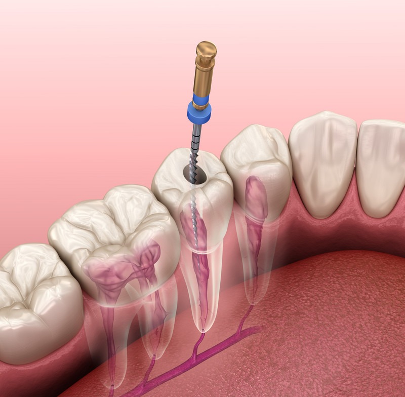 Root Canal Treatment on Front and Back Teeth
