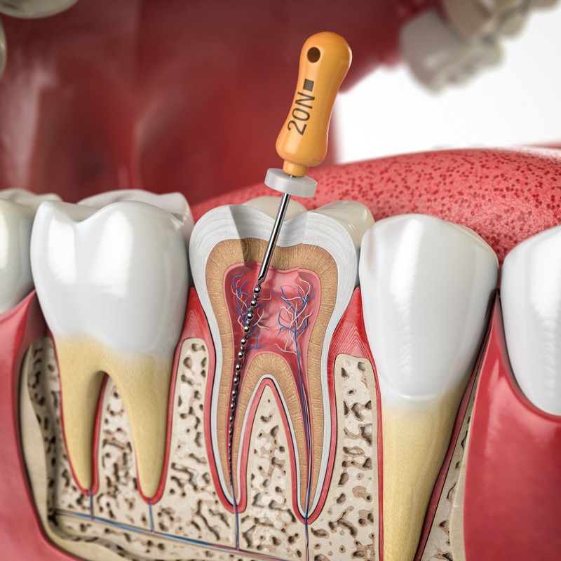 Root Canal Treatment on Front and Back Teeth
