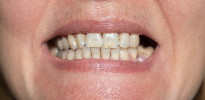 Root Canal Treatment on Front and Back Teeth