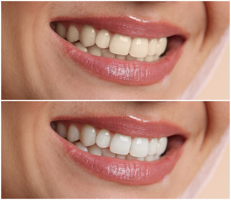 In-Office vs. At-Home Teeth Whitening: Which Option Is Best?