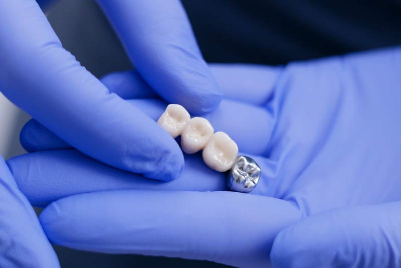 Why Do I Need a Dental Crown? Answers From a Laguna Hills Dentist