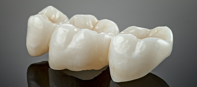 Why Do I Need a Dental Crown? Answers From a Laguna Hills Dentist